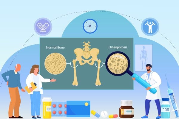 Osteoporosis comprehensive guide